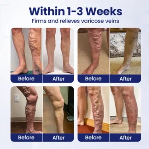 🏆🏆FDA approved🌿Furzero® VeinFreedom Herbal Spray - MicroMist Therapy