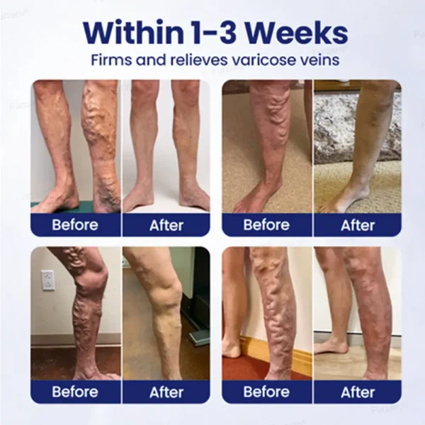 🏆🏆FDA approved🌿Furzero® VeinFreedom Herbal Spray - MicroMist Therapy