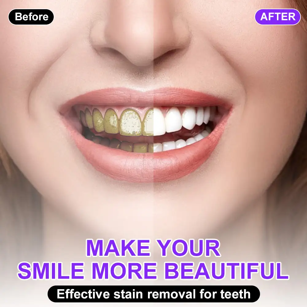 Furzero® Colour Corrector Serum – 🧑⚕️ FDA Certified Enamel-Safe Teeth Whitening & Stain Removal for Sensitive Teeth💜💜