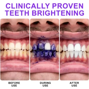 Furzero® Colour Corrector Serum – 🧑⚕️ FDA Certified Enamel-Safe Teeth Whitening & Stain Removal for Sensitive Teeth💜💜