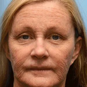 🎈👨⚕️Made and Shipped from the USA ✅Furzero™ Botox Bee Venom Wrinkle Removal Cream-Last Day Promotion 70% OFF