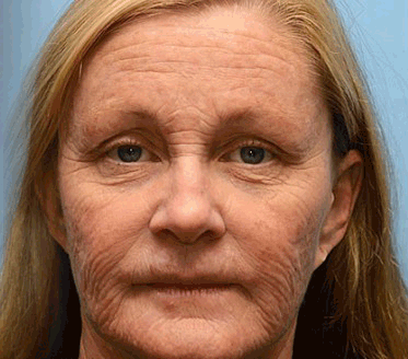 🎈👨⚕️Made and Shipped from the USA ✅Furzero™ Botox Bee Venom Wrinkle Removal Cream-Last Day Promotion 70% OFF