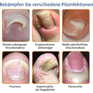 Alternative view of Furzero™ Bee Venom Nail Fungus Treatment Solution
